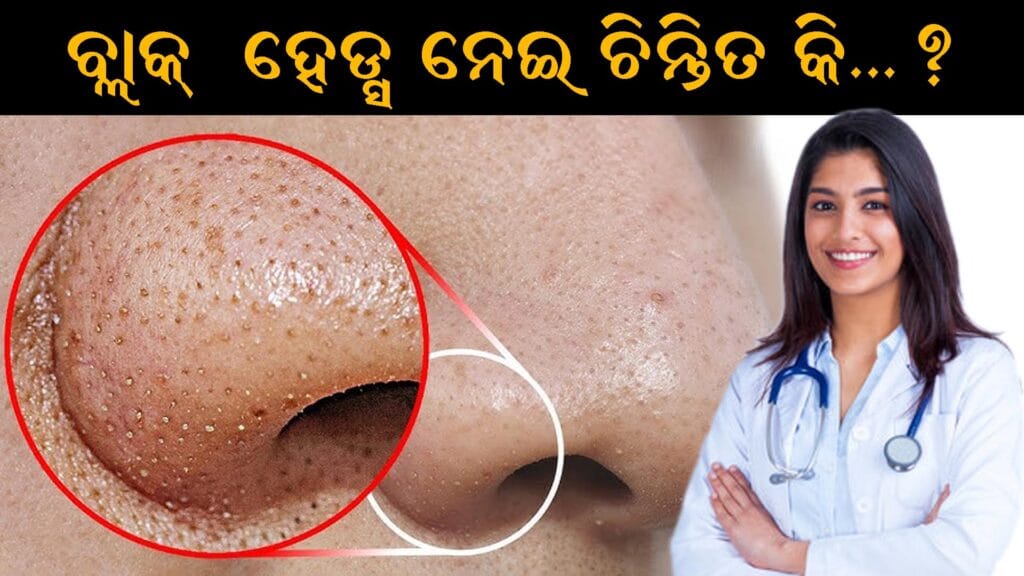 ନାକ ଓ ମୁହଁରେ ବ୍ଲାକ୍ ହେଡ୍ସ ଘଟିବା ସମସ୍ୟା ଓ ଘରୋଇ ଉପାୟ