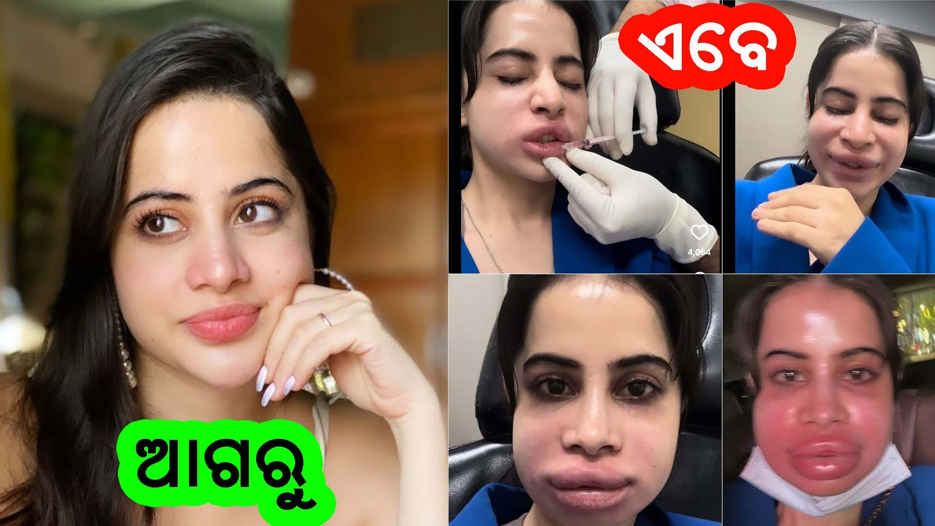 ଉର୍ଫି ଜାଭେଦ ତାଙ୍କର ଲିପ୍ ଫିଲର ହଟାଇବା ପରେ ହସ୍ପିଟାଲ ଭିତରୁ ଭିଡିଓ ଶେୟାର କରୁଛନ୍ତି, ମୁହଁ ଫୁଲା ଓ ଯନ୍ତ୍ରଣାରେ